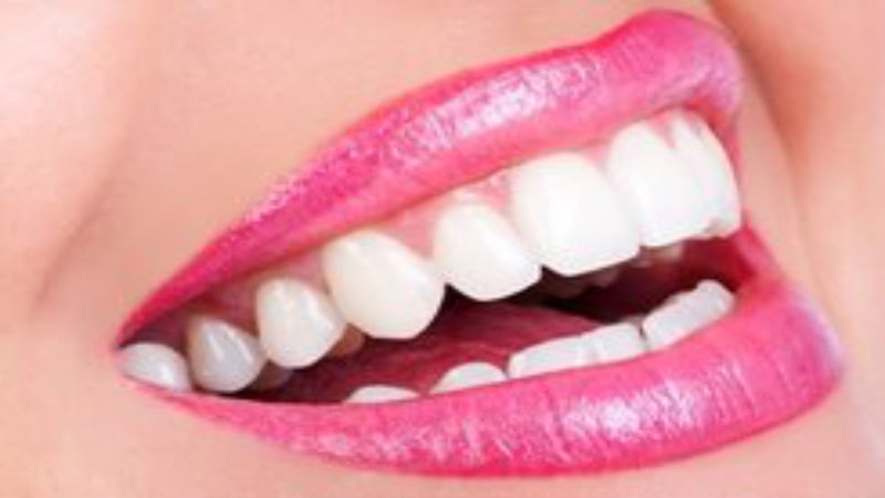 Professional Teeth Whitening in Chesterfield MO Can Help You Reclaim Your Smile