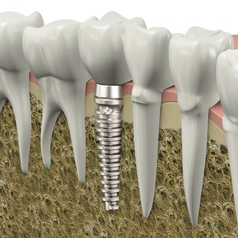 Find The Best Dental Implant Services In Your Area