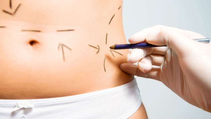 The Different Types of Liposuction