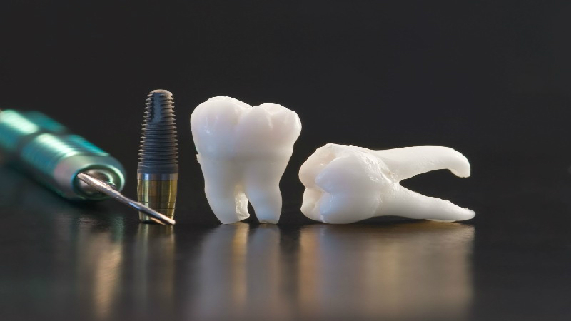 How to Heal From Dental Implants in Philadelphia