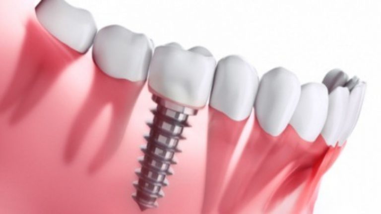 The Key Benefits of Chicago Dental Implants