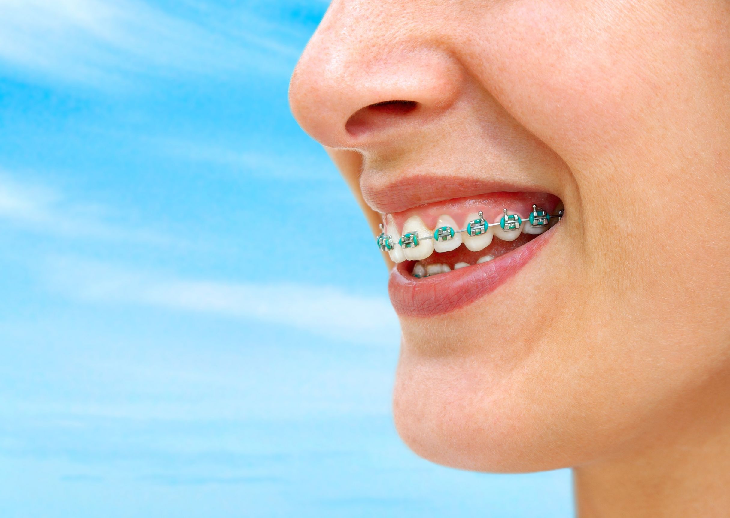 Benefits Of Invisalign For Teens In Medina OH